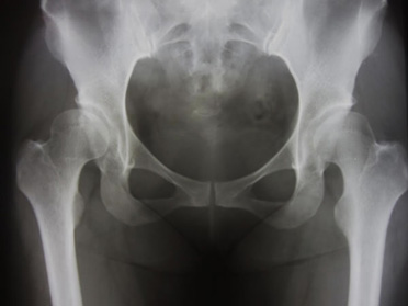 図3 37歳女性 右股関節痛 手術前